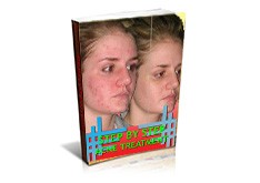 Step By Step Acne Treatment
